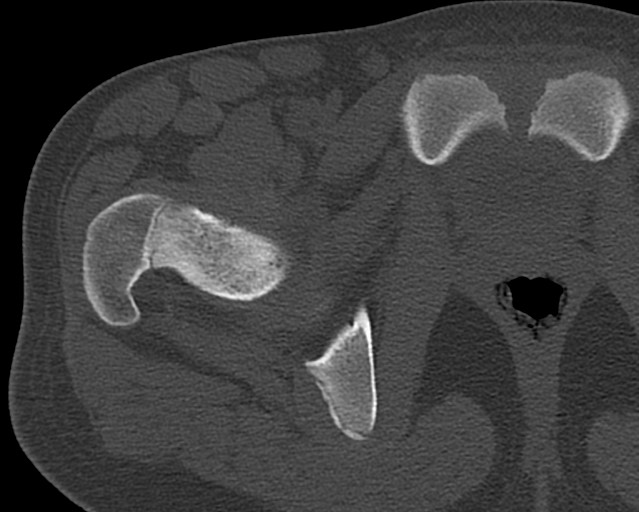 Chronic ostemyelitis of the femur with long sinus tract (Radiopaedia 74947-85982 Axial bone window 6).jpg