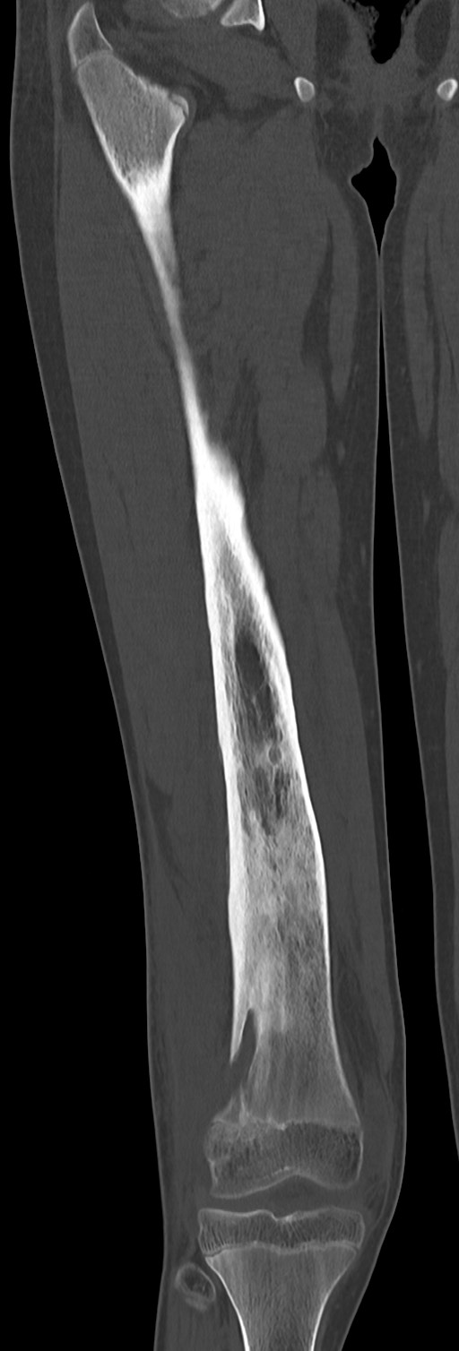 Chronic ostemyelitis of the femur with long sinus tract (Radiopaedia 74947-85982 Coronal bone window 43).jpg