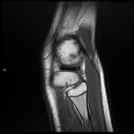 File:Chronic osteomyelitis (with Brodie abscess) (Radiopaedia 76405-88112 Sagittal PD 23).jpg