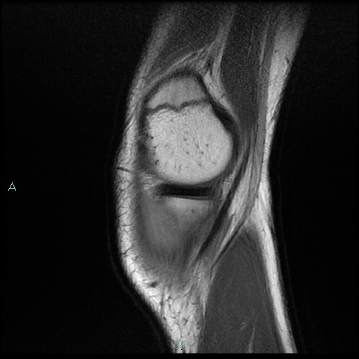 File:Chronic osteomyelitis (with Brodie abscess) (Radiopaedia 76405-88112 Sagittal PD 4).jpg