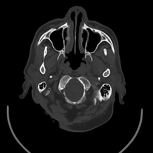 Chronic osteomyelitis - calvarial (severe) (Radiopaedia 69668-79616 Axial bone window 25).jpg