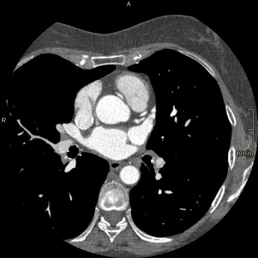 Chronic pulmonary embolism (Radiopaedia 73073-85094 Axial C+ CTPA 76).jpg