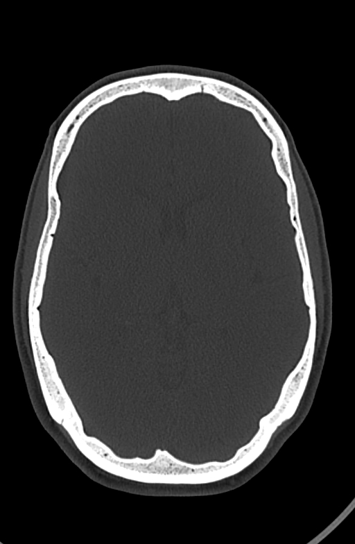 Chronic secondary hypoparathyroidism (Radiopaedia 74645-85601 Axial bone window 52).jpg