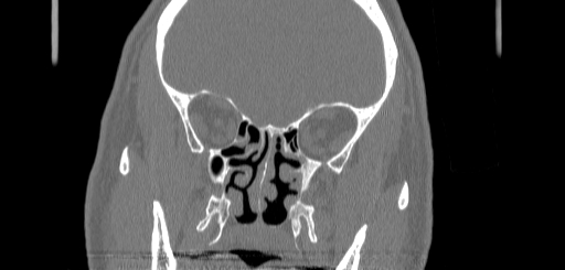 Chronic sphenoidal sinusitis (Radiopaedia 62030-70122 Coronal bone window 83).jpg