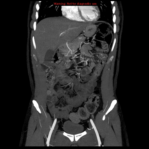 File:Circumaortic left renal vein (Radiopaedia 9069-9792 B 6).jpg