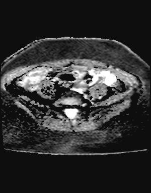 File:Class II Mullerian duct anomaly- unicornuate uterus with rudimentary horn and non-communicating cavity (Radiopaedia 39441-41755 Axial ADC 2).jpg