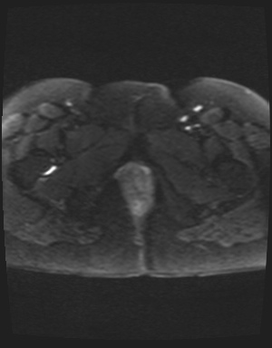 Class II Mullerian duct anomaly- unicornuate uterus with rudimentary horn and non-communicating cavity (Radiopaedia 39441-41755 Axial DWI 28).jpg
