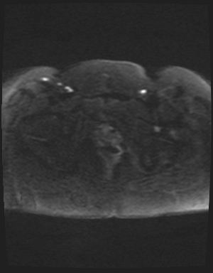 Class II Mullerian duct anomaly- unicornuate uterus with rudimentary horn and non-communicating cavity (Radiopaedia 39441-41755 Axial DWI 57).jpg