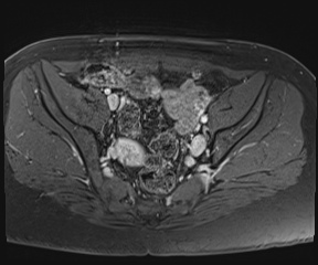 File:Class II Mullerian duct anomaly- unicornuate uterus with rudimentary horn and non-communicating cavity (Radiopaedia 39441-41755 Axial T1 fat sat 44).jpg