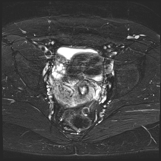 File:Class II Mullerian duct anomaly- unicornuate uterus with rudimentary horn and non-communicating cavity (Radiopaedia 39441-41755 Axial T2 fat sat 17).jpg