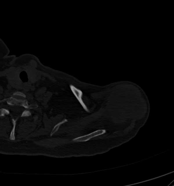 Clear cell chondrosarcoma - humerus (Radiopaedia 63104-71612 Axial bone window 16).jpg