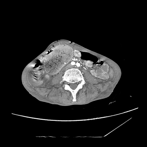 Closed-loop obstruction due to peritoneal seeding mimicking internal hernia after total gastrectomy (Radiopaedia 81897-95864 A 125).jpg