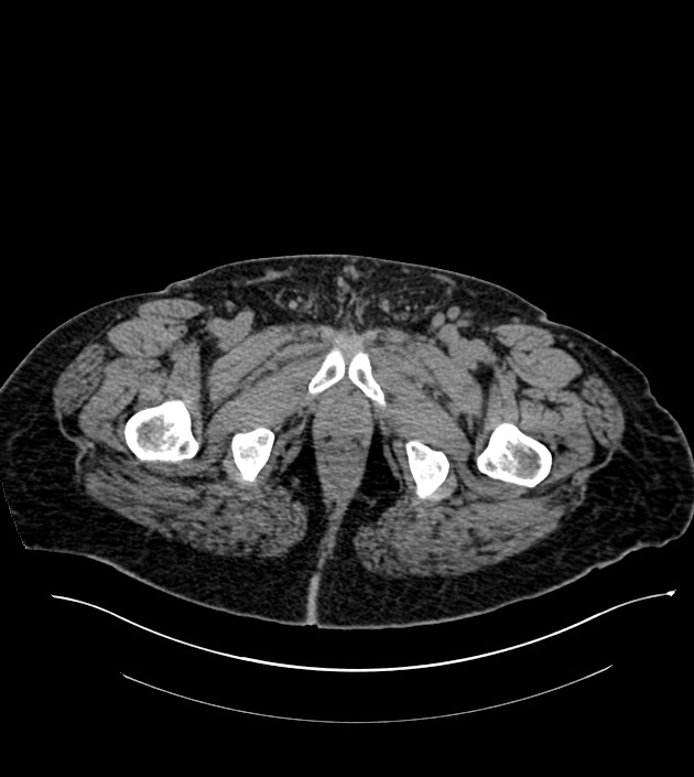 Closed-loop small bowel obstruction-internal hernia (Radiopaedia 78439-91096 Axial non-contrast 162).jpg