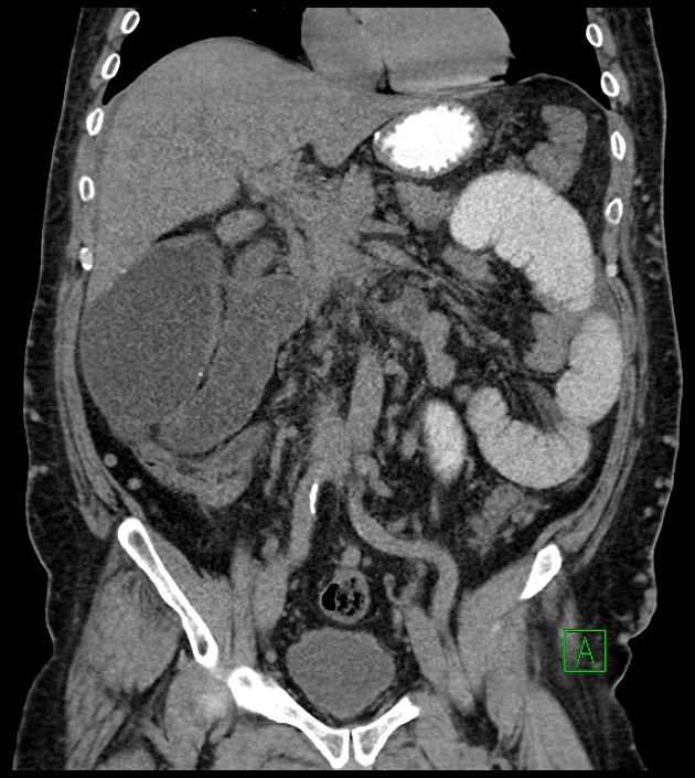 Closed-loop small bowel obstruction-internal hernia (Radiopaedia 78439-91096 Coronal non-contrast 49).jpg