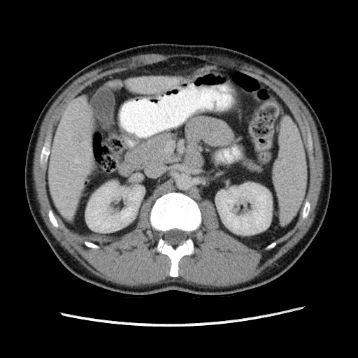 File:Closed-loop small bowel obstruction (Radiopaedia 73713-84509 A 62).jpg