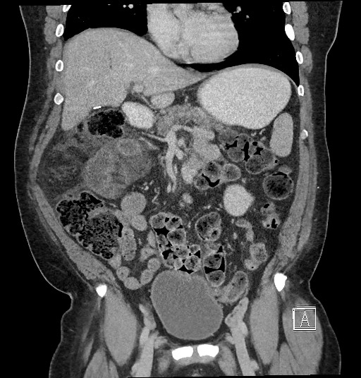 File:Closed loop obstruction - internal hernia into nephrectomy bed (Radiopaedia 59867-67320 B 57).jpg