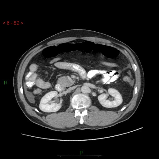 File:Closed loop obstruction and appendicular stump mucocele (Radiopaedia 54014-60163 A 43).jpg