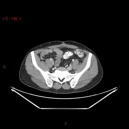 File:Closed loop obstruction and appendicular stump mucocele (Radiopaedia 54014-61158 A 61).jpg