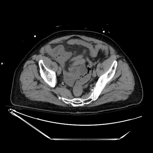 File:Closed loop obstruction due to adhesive band, resulting in small bowel ischemia and resection (Radiopaedia 83835-99023 Axial non-contrast 128).jpg