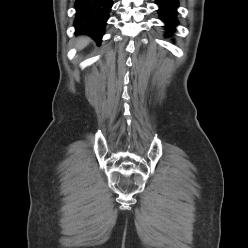 File:Closed loop obstruction due to adhesive band, resulting in small bowel ischemia and resection (Radiopaedia 83835-99023 C 109).jpg
