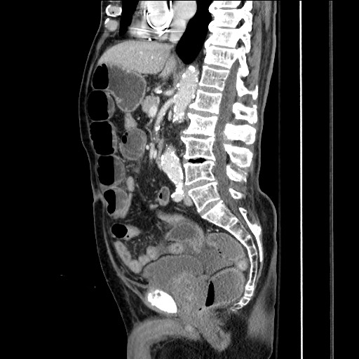 Closed loop obstruction due to adhesive band, resulting in small bowel ischemia and resection (Radiopaedia 83835-99023 F 97).jpg
