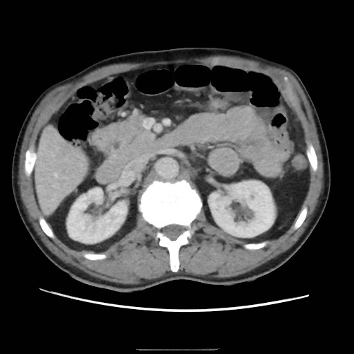 File:Closed loop small bowel obstruction (Radiopaedia 59227-66554 A 35).jpg