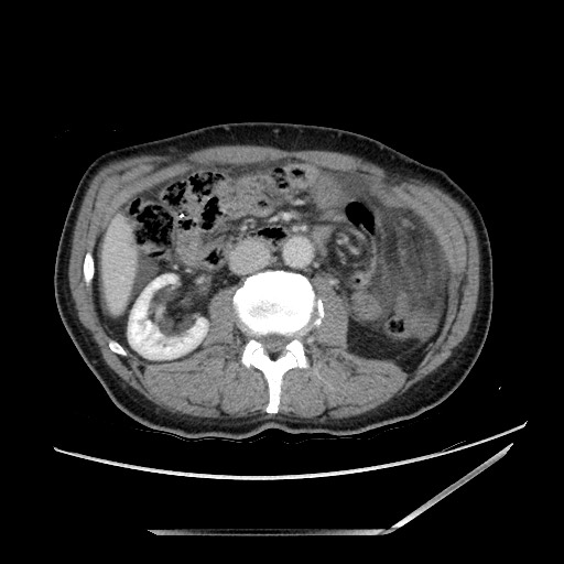 Closed loop small bowel obstruction - omental adhesion causing "internal hernia" (Radiopaedia 85129-100682 A 75).jpg