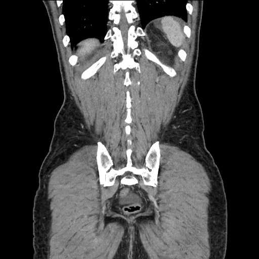 Closed loop small bowel obstruction - omental adhesion causing "internal hernia" (Radiopaedia 85129-100682 B 108).jpg