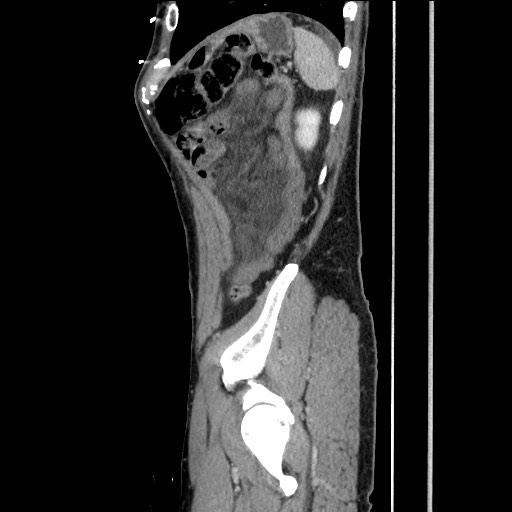 Closed loop small bowel obstruction - omental adhesion causing "internal hernia" (Radiopaedia 85129-100682 C 148).jpg
