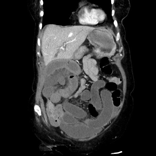 Closed loop small bowel obstruction due to adhesive band, with intramural hemorrhage and ischemia (Radiopaedia 83831-99017 C 37).jpg