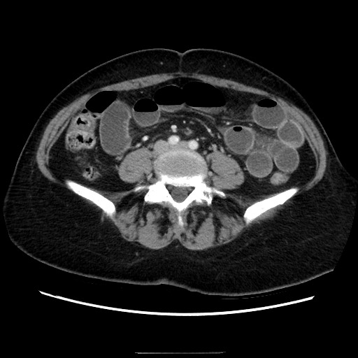 Closed loop small bowel obstruction due to adhesive bands - early and late images (Radiopaedia 83830-99015 A 103).jpg