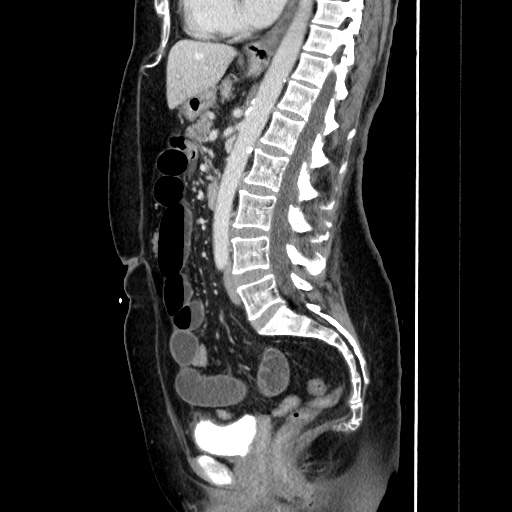 Closed loop small bowel obstruction due to adhesive bands - early and late images (Radiopaedia 83830-99015 C 95).jpg
