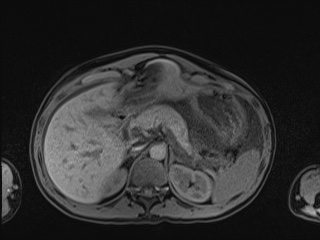 Closed loop small bowel obstruction in pregnancy (MRI) (Radiopaedia 87637-104031 Axial T1 fat sat 34).jpg
