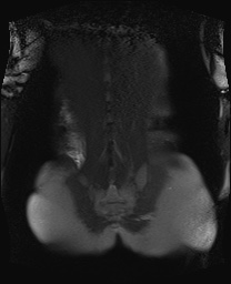 File:Closed loop small bowel obstruction in pregnancy (MRI) (Radiopaedia 87637-104031 Coronal T2 fat sat 48).jpg