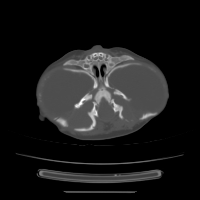 Cloverleaf skull (Radiopaedia 91901-109710 Axial bone window 50).jpg