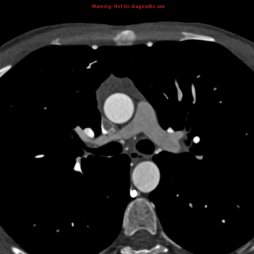 File:Coarctation of the aorta (Radiopaedia 12461-12697 A 176).jpg