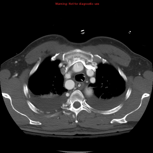 File:Coarctation of the aorta (Radiopaedia 8681-9490 B 18).jpg