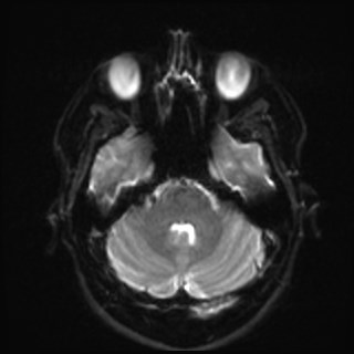 Cochlear incomplete partition type III associated with hypothalamic hamartoma (Radiopaedia 88756-105498 Axial DWI 11).jpg