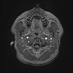 File:Cochlear incomplete partition type III associated with hypothalamic hamartoma (Radiopaedia 88756-105498 Axial T1 16).jpg