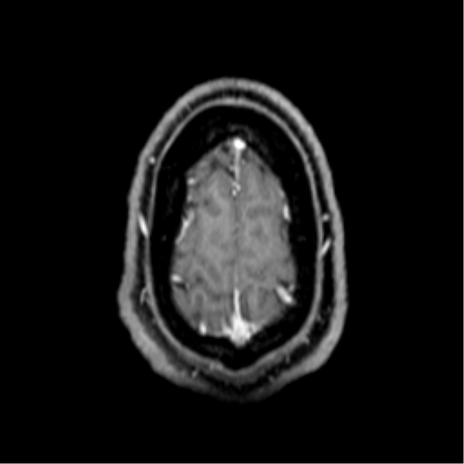 File:Colloid cyst (Radiopaedia 53164-59125 Axial T1 C+ fat sat 70).png