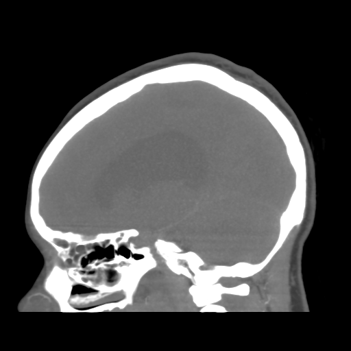 File:Colloid cyst (resulting in death) (Radiopaedia 33423-34499 B 24).png
