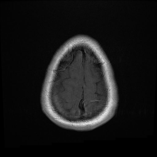 File:Colloid cyst with anterior communicating artery aneurysm (Radiopaedia 33901-35091 Axial T1 C+ 26).jpg