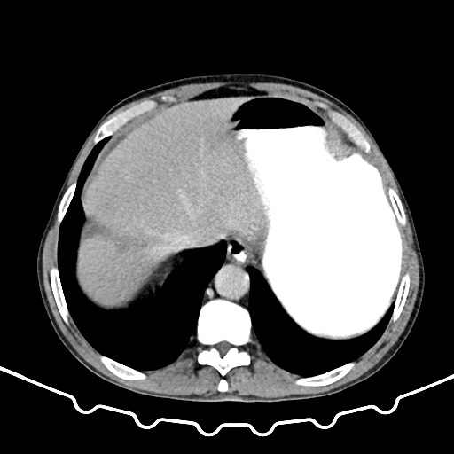 Colocolic intussusception due to large lipoma (Radiopaedia 68773-78482 A 16).jpg