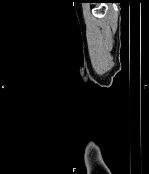 Colon adenocarcinoma (Radiopaedia 83266-97671 D 110).jpg