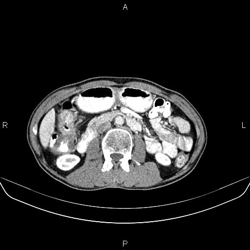 Colon adenocarcinoma - hepatic flexure (Radiopaedia 85635-101395 A 41).jpg