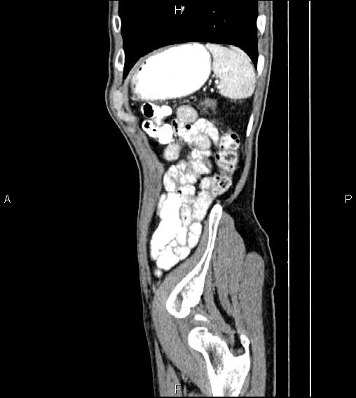 Colon adenocarcinoma - hepatic flexure (Radiopaedia 85635-101395 D 77).jpg