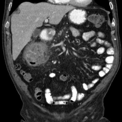 File:Colon cancer with duodenal invasion (Radiopaedia 16278-15958 B 21).jpg