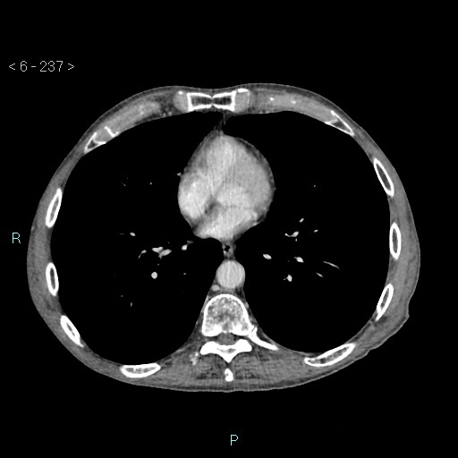 File:Colonic cancer (ultrasound and TC imaging) (Radiopaedia 50346-55713 B 237).jpg