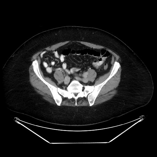 File:Colonic intussusception due to adenocarcinoma (Radiopaedia 86828-102987 A 108).jpg