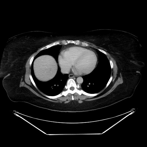 File:Colonic intussusception due to adenocarcinoma (Radiopaedia 86828-102987 A 13).jpg